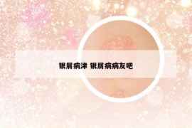 銀屑病津 銀屑病病友吧