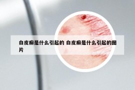 白皮癬是什么引起的 白皮癬是什么引起的圖片