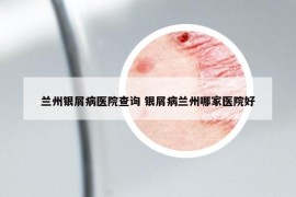 蘭州銀屑病醫(yī)院查詢 銀屑病蘭州哪家醫(yī)院好