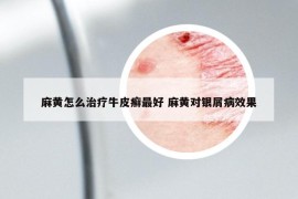 麻黃怎么治療牛皮癬最好 麻黃對(duì)銀屑病效果