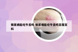 銀屑病能吃牛舌嗎 銀屑病能吃牛舌嗎百度百科