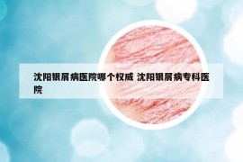 沈陽(yáng)銀屑病醫(yī)院哪個(gè)權(quán)威 沈陽(yáng)銀屑病?？漆t(yī)院
