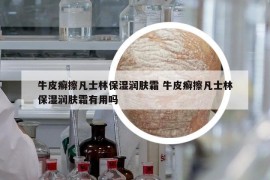 牛皮癬擦凡士林保濕潤(rùn)膚霜 牛皮癬擦凡士林保濕潤(rùn)膚霜有用嗎