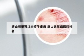 唐山哪里可以治療牛皮癬 唐山銀屑病醫(yī)院排名