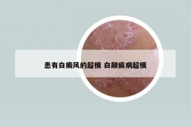 患有白癜風的超模 白顛瘋病超模