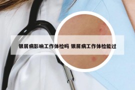 銀屑病影響工作體檢嗎 銀屑病工作體檢能過