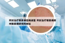 開封治療銀屑病佳楊淑蓮 開封治療銀屑病鄭州銀屑病研究院地址