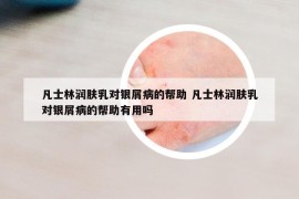 凡士林潤(rùn)膚乳對(duì)銀屑病的幫助 凡士林潤(rùn)膚乳對(duì)銀屑病的幫助有用嗎