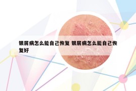 銀屑病怎么能自己恢復(fù) 銀屑病怎么能自己恢復(fù)好