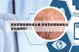 膿包型銀屑病快速止痛 膿包型的銀屑病有治愈的案例嗎?