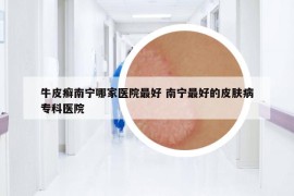 牛皮癬南寧哪家醫(yī)院最好 南寧最好的皮膚病?？漆t(yī)院
