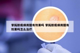掌跖膿皰病用醋有效果嗎 掌跖膿皰病用醋有效果嗎怎么治療
