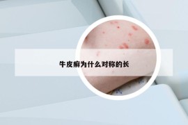 牛皮癬為什么對稱的長