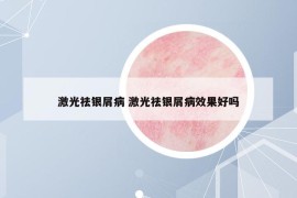 激光祛銀屑病 激光祛銀屑病效果好嗎