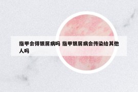指甲會(huì)得銀屑病嗎 指甲銀屑病會(huì)傳染給其他人嗎