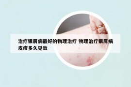 治療銀屑病最好的物理治療 物理治療銀屑病皮疹多久見(jiàn)效