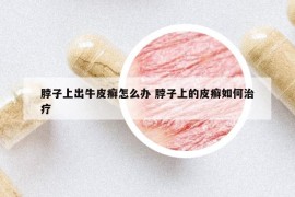 脖子上出牛皮癬怎么辦 脖子上的皮癬如何治療