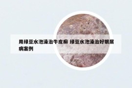 用綠豆水泡澡治牛皮癬 綠豆水泡澡治好銀屑病案例
