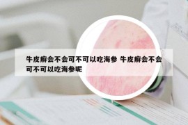 牛皮癬會不會可不可以吃海參 牛皮癬會不會可不可以吃海參呢