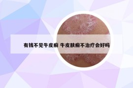 有錢不見牛皮癬 牛皮膚癬不治療會好嗎