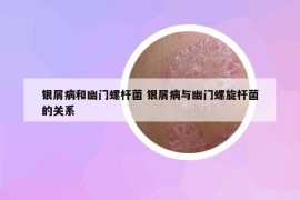銀屑病和幽門螺桿菌 銀屑病與幽門螺旋桿菌的關(guān)系