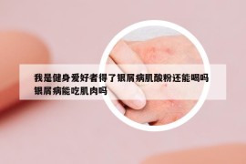 我是健身愛(ài)好者得了銀屑病肌酸粉還能喝嗎 銀屑病能吃肌肉嗎