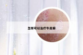 怎樣可以治療牛皮癬