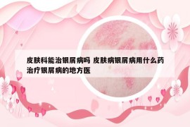 皮膚科能治銀屑病嗎 皮膚病銀屑病用什么藥治療銀屑病的地方醫(yī)