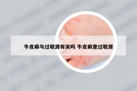 牛皮癬與過敏源有關(guān)嗎 牛皮癬查過敏源