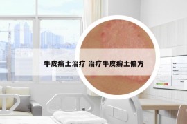 牛皮癬土治療 治療牛皮癬土偏方