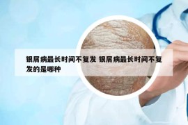 銀屑病最長時間不復發(fā) 銀屑病最長時間不復發(fā)的是哪種