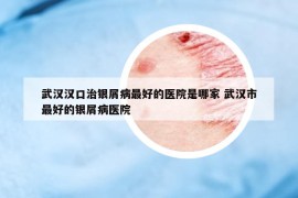 武漢漢口治銀屑病最好的醫(yī)院是哪家 武漢市最好的銀屑病醫(yī)院