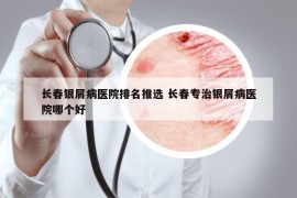 長春銀屑病醫(yī)院排名推選 長春專治銀屑病醫(yī)院哪個(gè)好