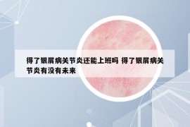 得了銀屑病關(guān)節(jié)炎還能上班嗎 得了銀屑病關(guān)節(jié)炎有沒有未來