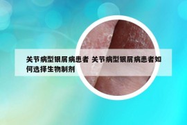 關(guān)節(jié)病型銀屑病患者 關(guān)節(jié)病型銀屑病患者如何選擇生物制劑
