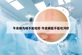 牛皮癬為啥不能吃蝦 牛皮癬能不能吃河蝦