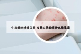 牛皮癬吃啥維生素 皮膚過(guò)敏缺乏什么維生素