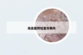 南昌醫(yī)院檢查白癜風
