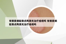 有銀屑病能做點陣激光治療痤瘡嗎 有銀屑病能做點陣激光治療痤瘡嗎