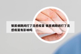 銀屑病期間打了流感疫苗 銀屑病期間打了流感疫苗有影響嗎