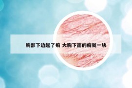 胸部下邊起了癬 大胸下面的癬就一塊