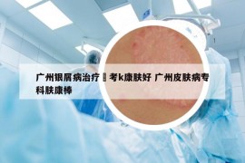 廣州銀屑病治療參考k康膚好 廣州皮膚病?？颇w康棒