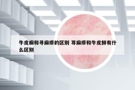 牛皮癬和尋麻疹的區(qū)別 蕁麻疹和牛皮鮮有什么區(qū)別