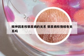 精神因素和銀屑病的關(guān)系 銀屑病和情緒有關(guān)系嗎
