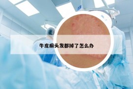牛皮癬頭發(fā)都掉了怎么辦