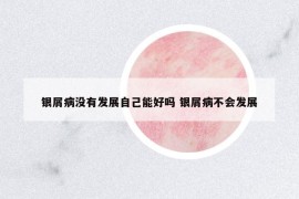 銀屑病沒有發(fā)展自己能好嗎 銀屑病不會(huì)發(fā)展