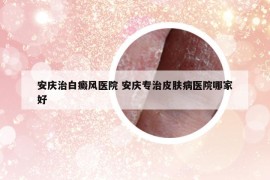 安慶治白癜風(fēng)醫(yī)院 安慶專治皮膚病醫(yī)院哪家好