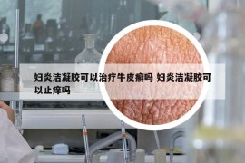 婦炎潔凝膠可以治療牛皮癬嗎 婦炎潔凝膠可以止癢嗎