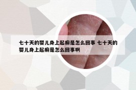 七十天的嬰兒身上起癬是怎么回事 七十天的嬰兒身上起癬是怎么回事啊