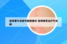 昆明看牛皮癬中醫(yī)哪里好 昆明哪家治療牛皮癬